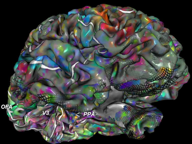 Новая кора головного мозга на приборе МРТ