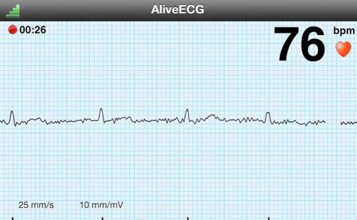 AliveCor показывает в реальном времени кардиограмму, отмечает интервалы между зубцами R и вычисляет частоту сердечных сокращений (кадр из демо-ролика)