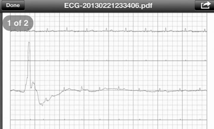 Пример кардиограммы, записанной в программе AliveCor (кадр из деморолика)