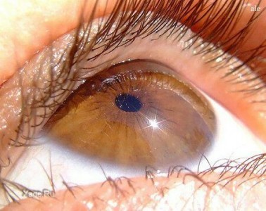 Ученые разработали и запатентовали новый вид протеза сетчатки глаза