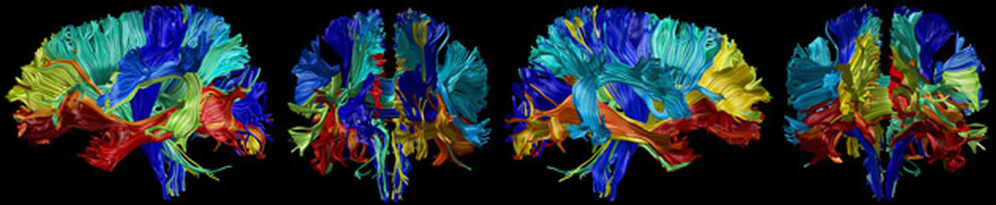 Сокращение объема нижних отделов мозга с возрастом. Иллюстрации Physorg